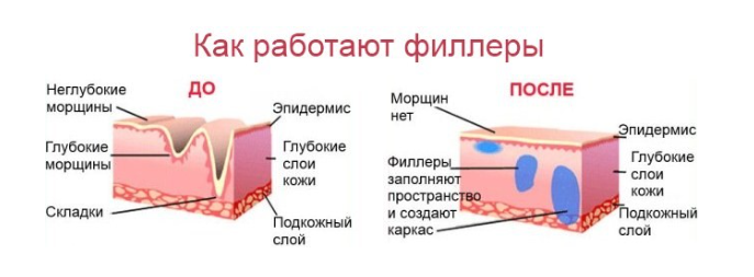 Контурная пластика подбородка